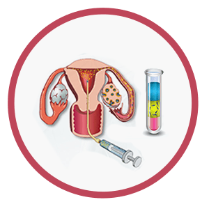 Intrauterine insemination-IUI